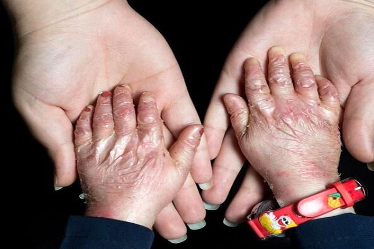 بیماران پروانه ای