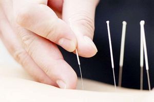 طب سوزنی ۹۰ درصد در ترک اعتیاد تاثیرگذار است / اصلاح مزاج به دفع سموم از بدن فرد معتاد کمک می‌کند