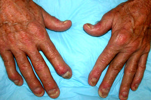 درمان‌های طبیعی برای عارضه آرتریت پسوریاتیک