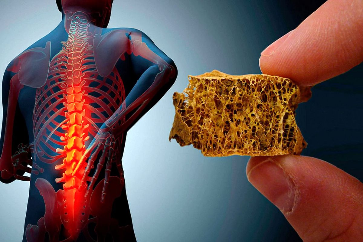 پوکی استخوان 