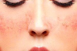 راهنمای جامع مراقبت از پوست های حساس / نکات و راهکارهای مفید برای پوست مشکل‌دار