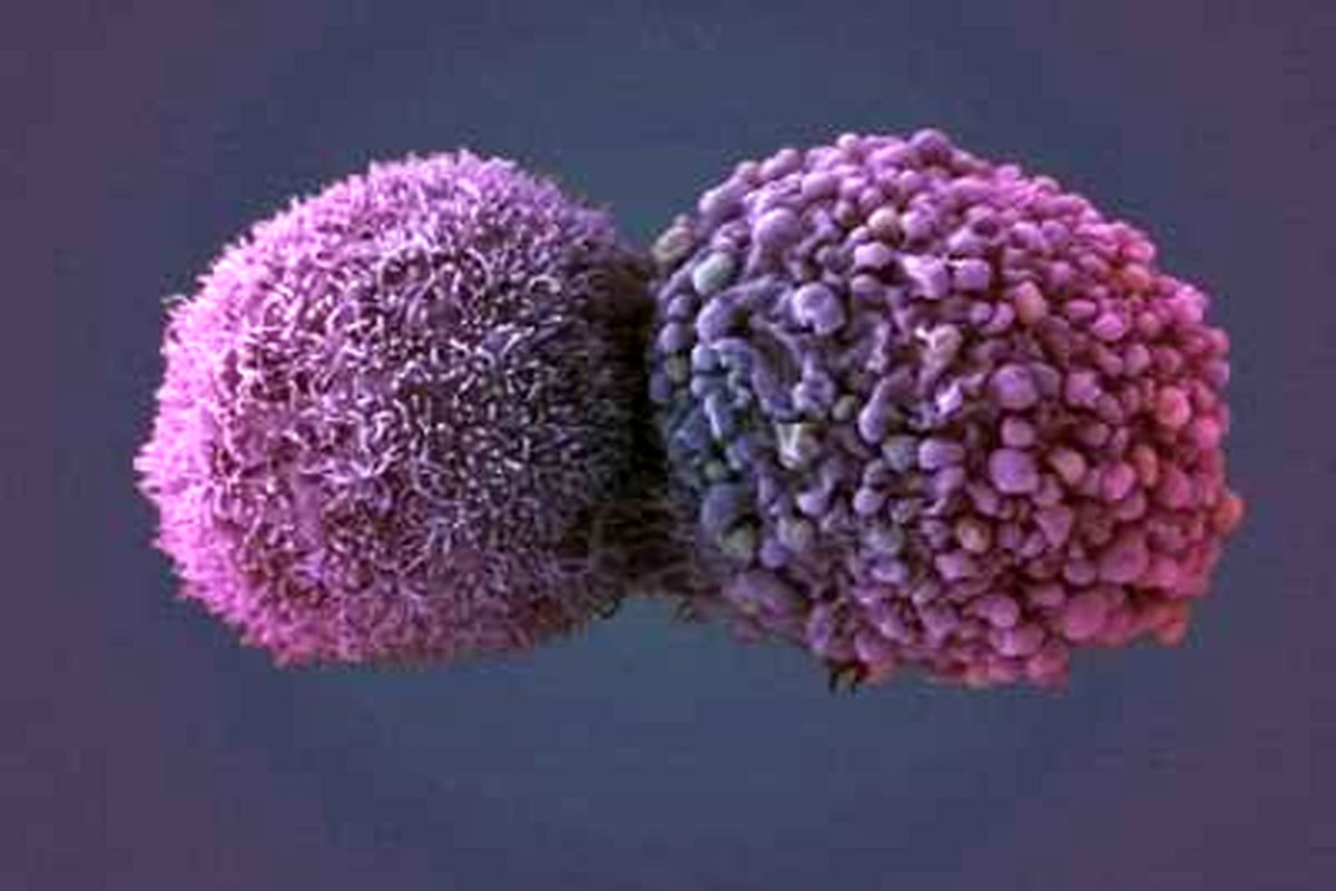 سلول سرطانی