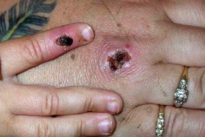 شناسایی اولین مورد ابتلا به آبله میمون در امارات متحده