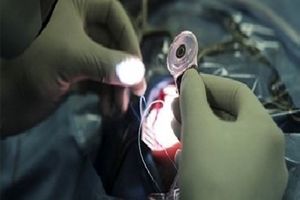 افتتاح مرکز کاشت حلزون شنوایی در کرمانشاه