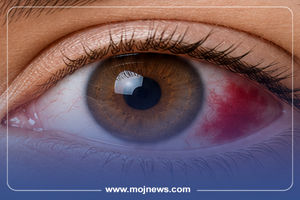 اینفوگرافیک/دلایل پارگی رگ خونی در چشم؛ چه موقع باید به پزشک مراجعه کنیم؟