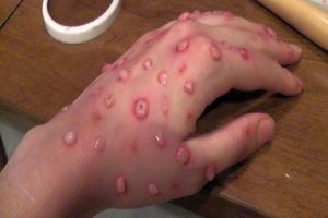 پیشگیری از بیماری آبله میمونی با استفاده از ماسک و پروتکل‌های بهداشتی