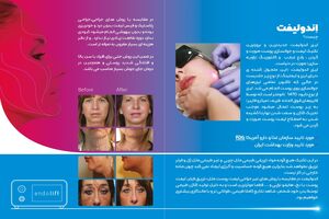 رونمایی از اولین لیزر اندولیفت در اصفهان