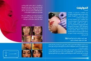 رونمایی از اولین لیزر اندولیفت در اصفهان