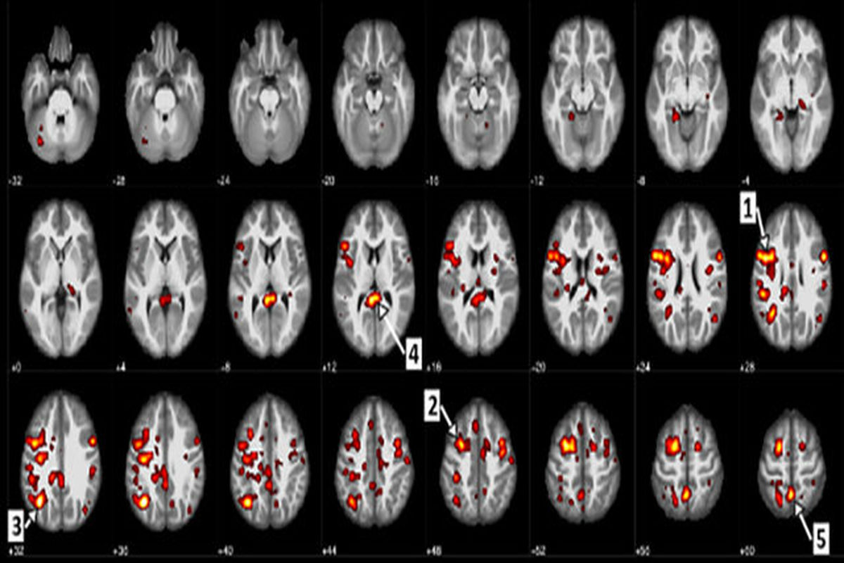 تشخیص اسکیزوفرنی