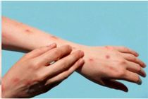 ضایعات پوستی آبله میمونی بیشتر در کدام قسمت های بدن ظاهر میشوند؟