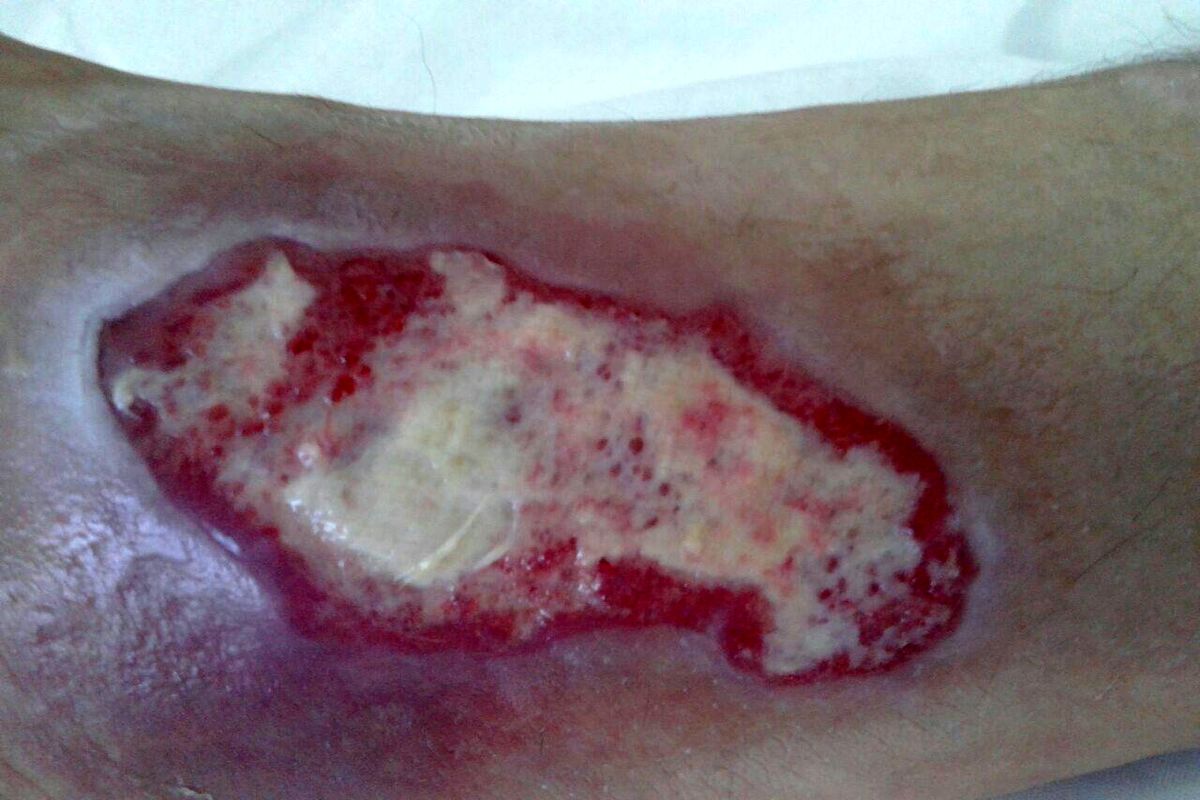 ترمیم زخم بستر