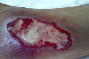 سرعت در بهبود التیام زخم با بانداژ حاوی پروتئین سویا