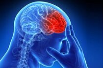 سکته مغزی چیست و چه اشتباهاتی موجب آن می‌شود؟