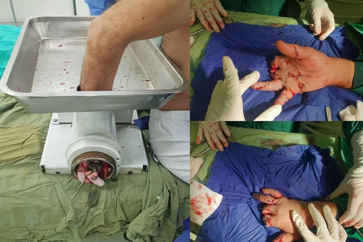 پیوند انگشت