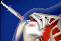 سلول‌های بنیادی آسیب‌های نخاعی را بازسازی می‌کنند