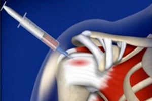 سلول‌های بنیادی آسیب‌های نخاعی را بازسازی می‌کنند