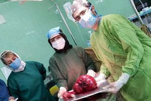 خروج توده پنج کیلویی از شکم یک زن ۴۲ ساله 