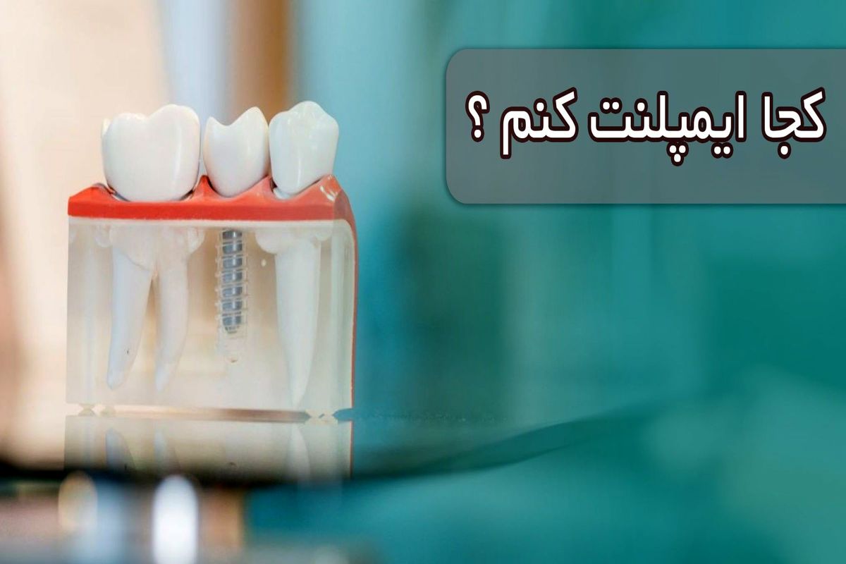 ایمپلنت