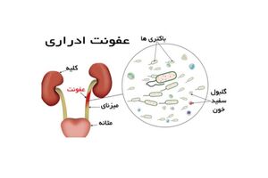 راه حل ساده برای جلوگیری از عفونت مجاری ادراری
