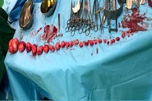 خارج کردن 27 توده از رحم دختر بندرعباسی