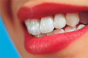 مشاهده دندان های اصلاح شده پیش از جراحی