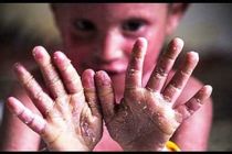 رئیس سازمان غذا و دارو: 550 فرد مبتلا بیماری پروانه ای در کشور شناسایی  شدند