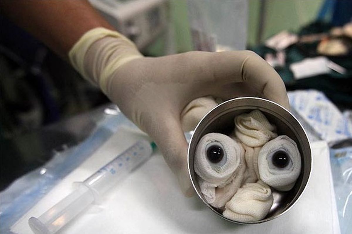 پیوند قرنیه