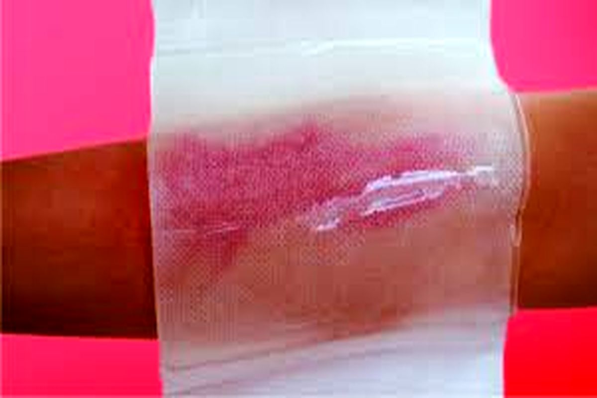 پانسمان جدید درمان سوختگی