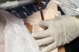 امدادرسانی آتش‌نشانی بندرعباس در حادثه فرو رفتن جسم نوک‌تیز در بدن یک شهروند