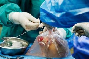 اهدا اعضای بدن یک بیمار مرگ مغزی در قم