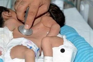 دوقلوهای به هم چسبیده در شیراز از یکدیگر جدا شدند