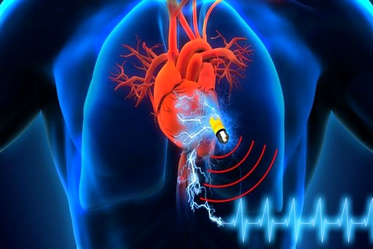 شارژ ایمپلنت