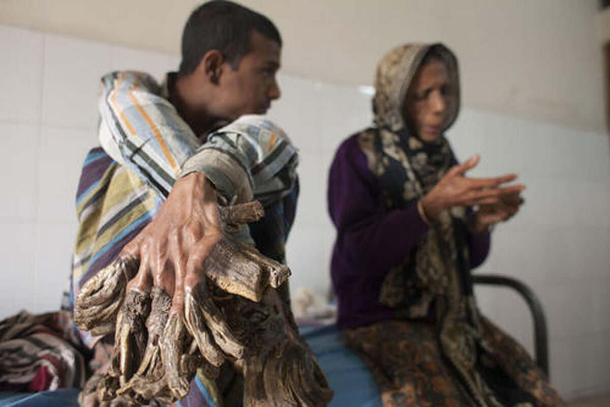بیماری مرد درختی