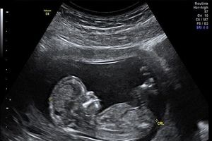 توزیع کیت‌های استاندارد غربالگری محدودیتی ندارد