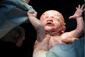 دومین نوزاد متولد شده از مادر مبتلا به اچ ای وی مثبت سالم به دنیا آمد