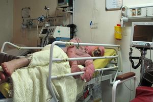 میزان آتش سوزی در ایران ۸ برابر جهان است / اتاق ۶ تخته برای مصدومان سوختگی تنها مرگ در پی دارد