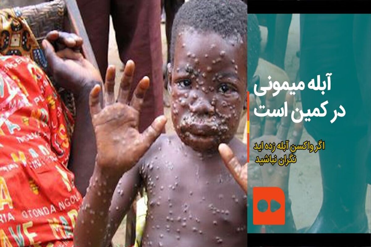 آبله میمون