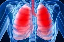 سومین عامل مرگ و میر در جهان در سال ۲۰۳۰ انسداد ریه است