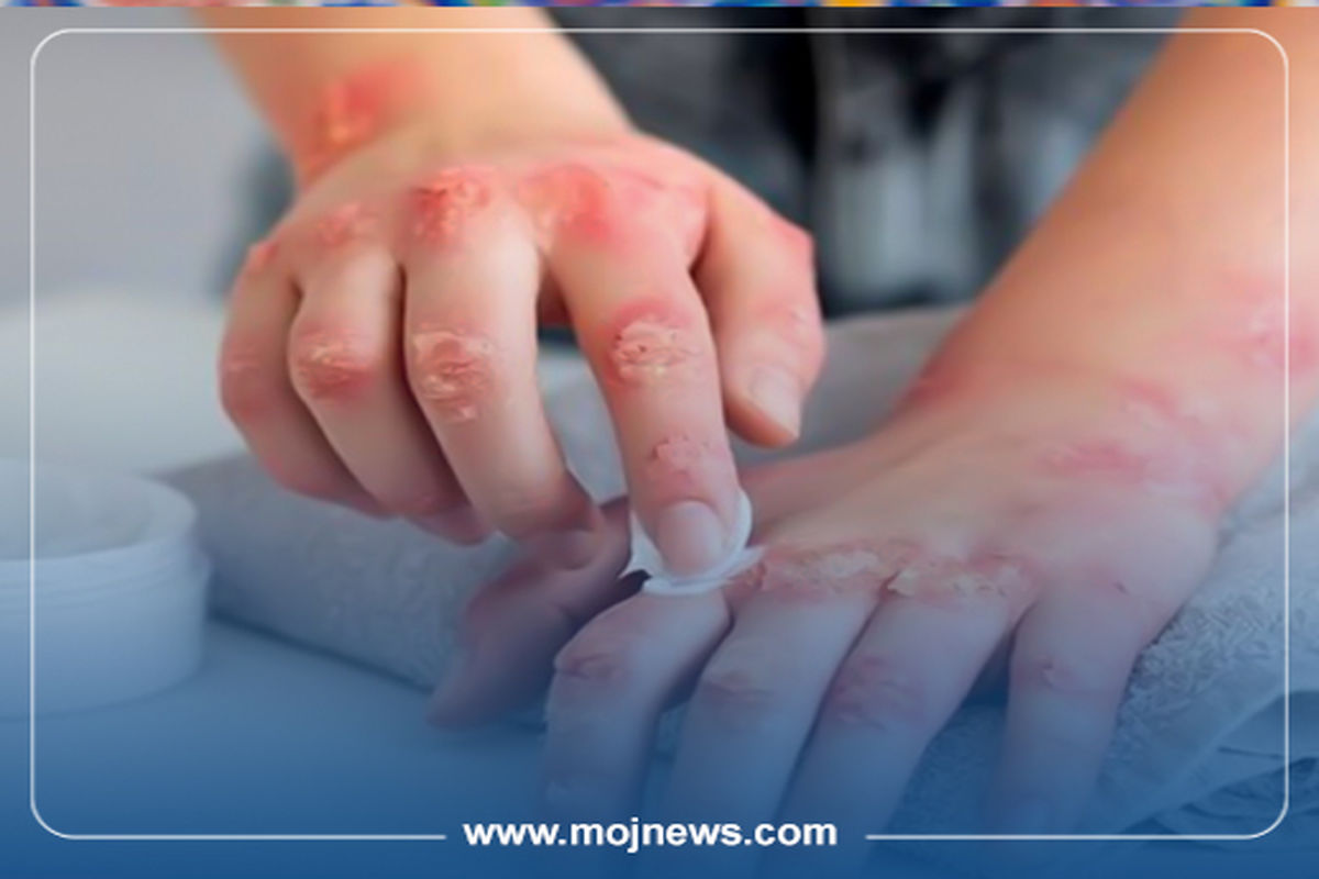 اگزمای پاییزی موج