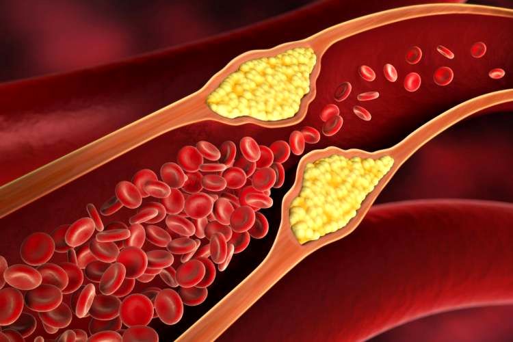 گرفتگی عروق قلب را چگونه با طب سنتی درمان کنیم؟