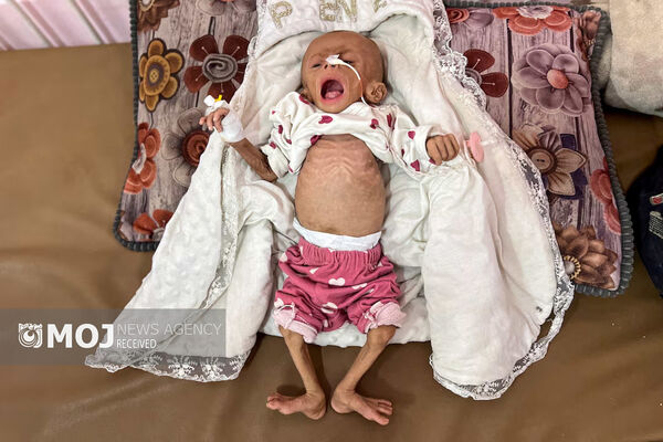 ۲۴۰۰ کودک غزه در خطر مرگ از گرسنگی هستند