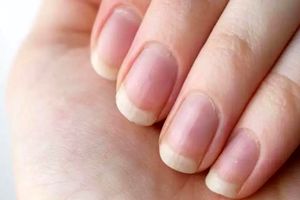 ناهنجاری‌های ناخن و علائم آن