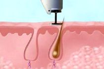 علائم تاثیر لیزر روی موهای زائد/ مزایا و عوارض لیزر موهای زائد چیست