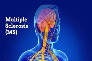 شناسایی خطر ابتلا اطفال  به ام‌اس 