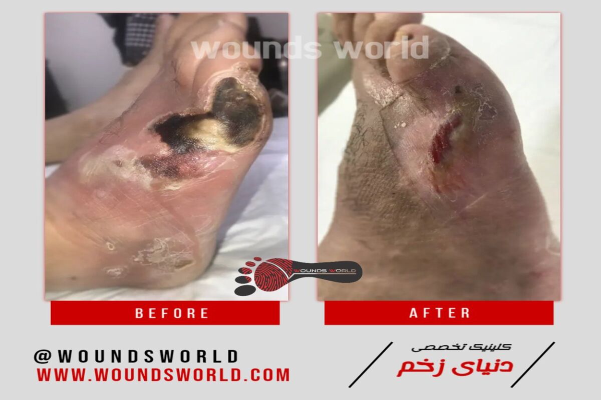 دیابت