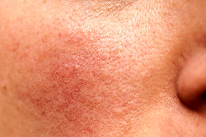 وزارت بهداشت به ورود پزشکان عمومی به حوزه پوست واکنش نشان داد