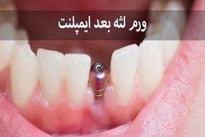 ورم لثه بعد از ایمپلنت