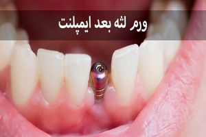 ورم لثه بعد از ایمپلنت