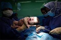 نرخ سزارین در کرمانشاه ۲.۵ برابر میانگین استاندارد است