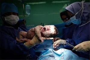 نرخ سزارین در کرمانشاه ۲.۵ برابر میانگین استاندارد است